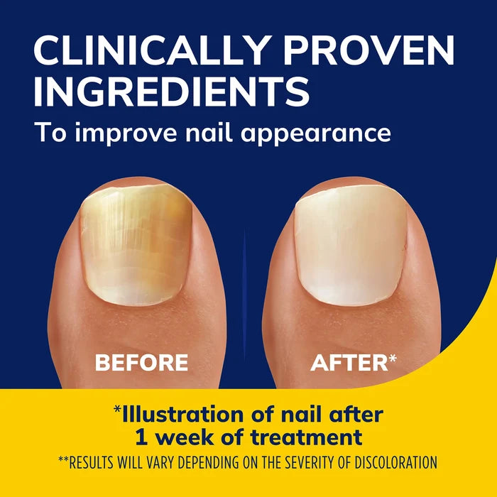 Before-and-after nail appearance illustration for light-activated nail treatment