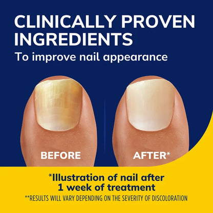 Before-and-after nail appearance illustration for light-activated nail treatment