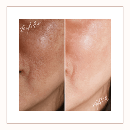 Close-up before and after of facial skin showing smoother texture and refined pores after consistent use of Reiland Luxury Exfoliating Facial Pads.